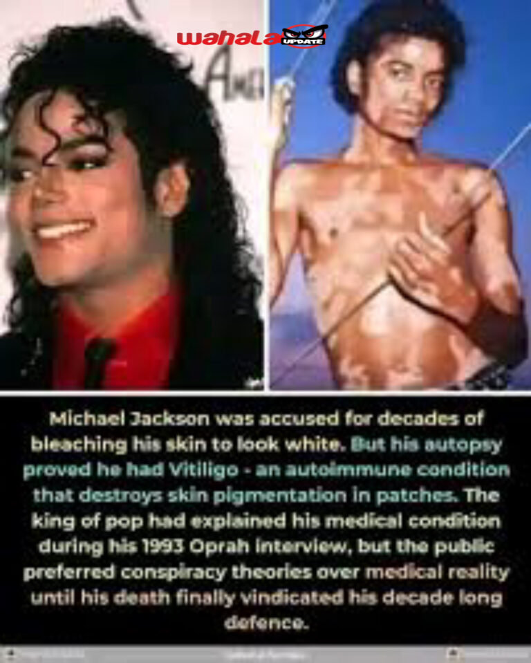 The Michael Jackson Skin color : Debunking The Vitiligo Myth